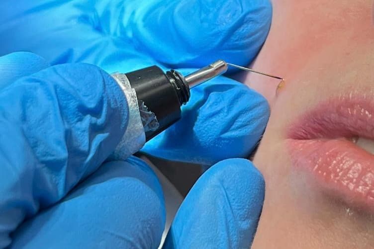 Skin Lesion Removal
